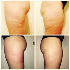 Endermologie-before-after-women